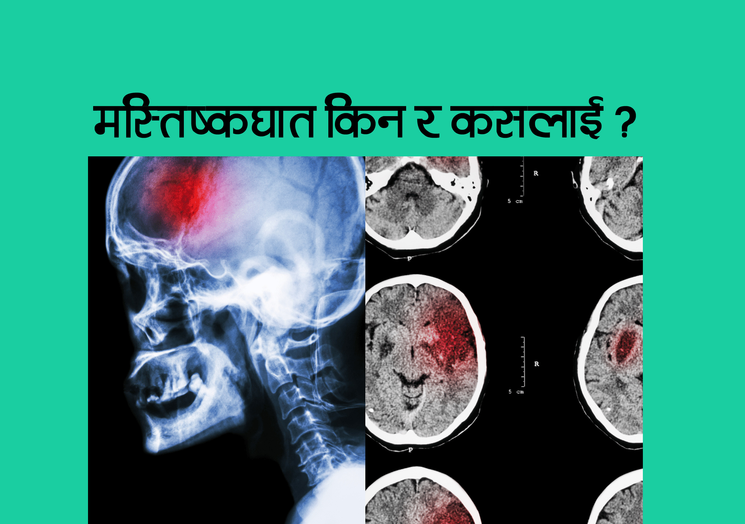 कसलाई हुन्छ मस्तिष्काघात ?